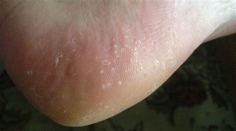 Pimples On Bottom Of Feet Pictures Photos