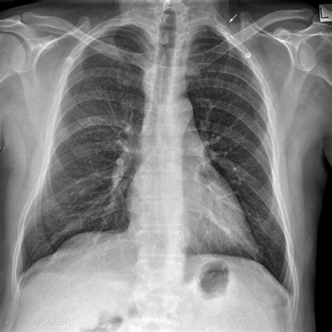 Chest Normal Anatomical Variants Wikiradiography