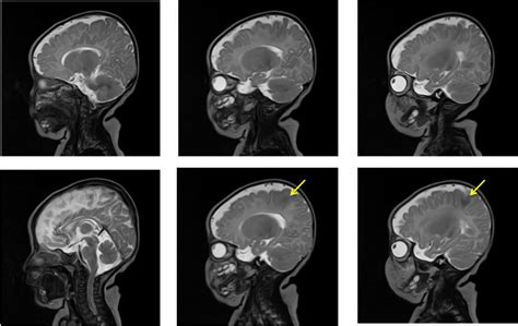 Focal Cortical Dysplasia Radiology Cases