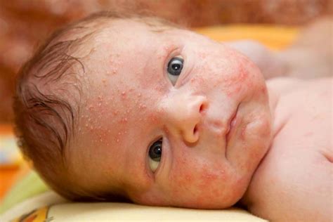 علل و نحوه ی درمان اصولی جوش صورت نوزاد طبق تحقیقات روز دنیا قطعی سالم زیبا