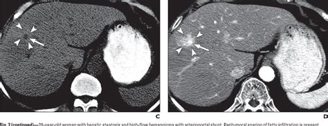 Figure 1—50 From Sparing Of Fatty Infiltration Around Focal Hepatic