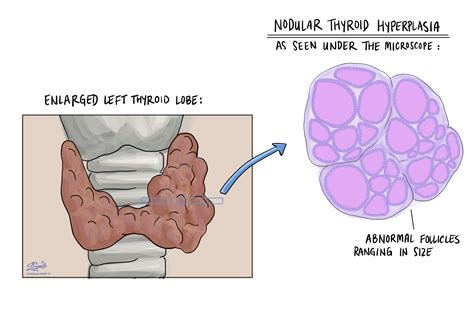 Nodular Thyroid Hyperplasia Mypathologyreportca