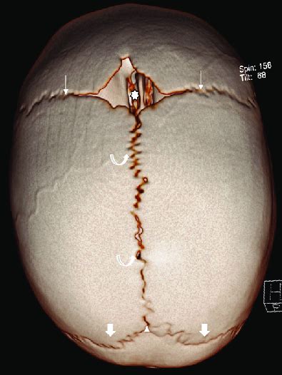 Normal Sutures And Fontanelles Volume Rendered Vr Image Of The