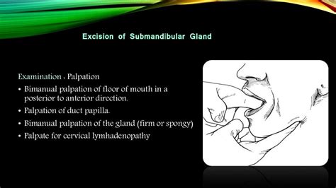 Submandibular Gland Excision