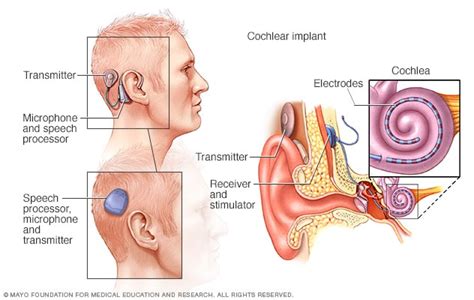 Cochlear Implants Mayo Clinic