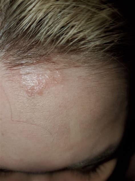 Is This Ringworm On My Hairlinetop Of Forehead Dermatologyquestions
