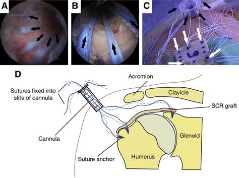 Arthroscopic Suture Management During Superior Capsular Reconstruction