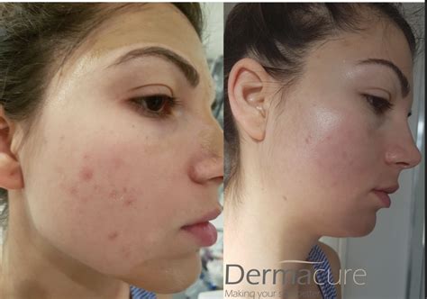 Cosmelan Peel London Number 1 Depigmentation Treatment Dermacure Clinic