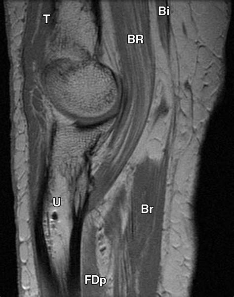 Distal Attachment Of The Brachialis Muscle Anatomic And Mri Study In
