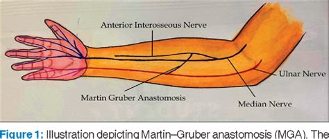 Figure 1 From Nerve Conduction Study Findings In Ulnar Median Nerve