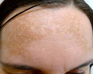 It might have been caused by sunburn, inflammation, injuries or even acne. Melasma Treatment and Cause Explain - Natural Beauty Cream