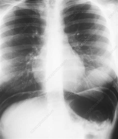 Key concept the respiratory system gets oxygen and removes. Abdominal air pockets, X-ray - Stock Image - M240/0506 - Science Photo Library