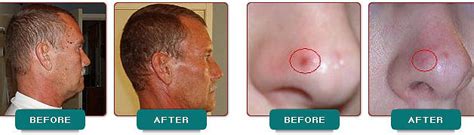 Being enerally harmless, they do not need treatment unless there is bleeding. Angiomas/Hemangioma Removal - Skin 101 Medical Spa