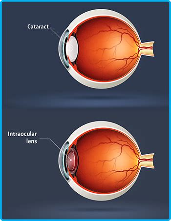 Aging is the most common cause. Convenient, affordable private cataract surgery Norfolk ...