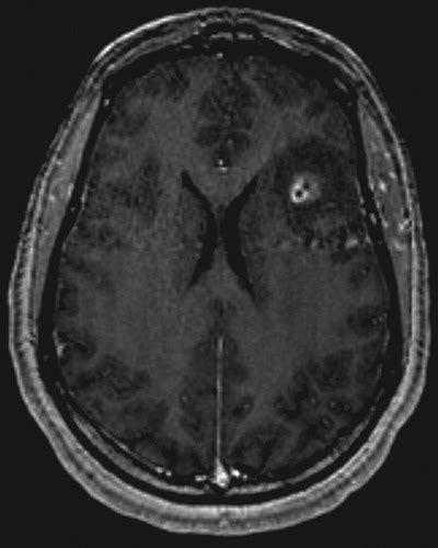 Neuro Lyme Disease Mr Imaging Findings Radiology
