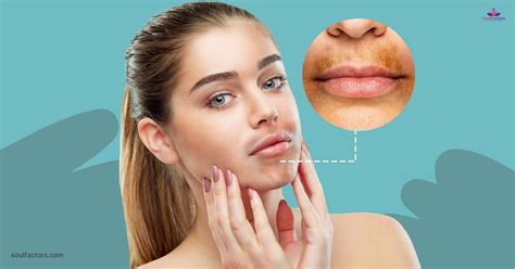 Hyperpigmentation Around The Mouth Causes And Treatment