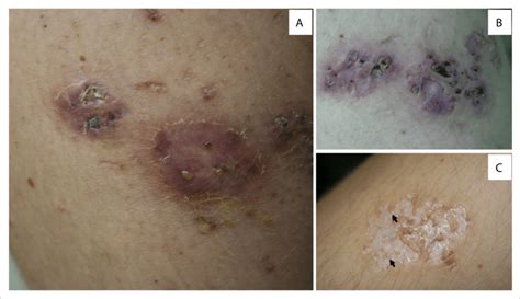 Acquired Perforating Dermatosis Secondary To Nutritional Deficiency