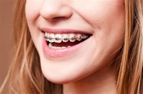 Why You Should Wear Your Retainer After Braces New Braunfels Braces