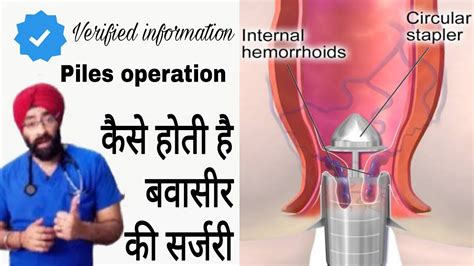 Piles Surgery Hemorrhoids Operation Dr Education