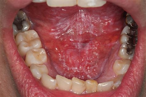 Lesions In Floor Of Mouth