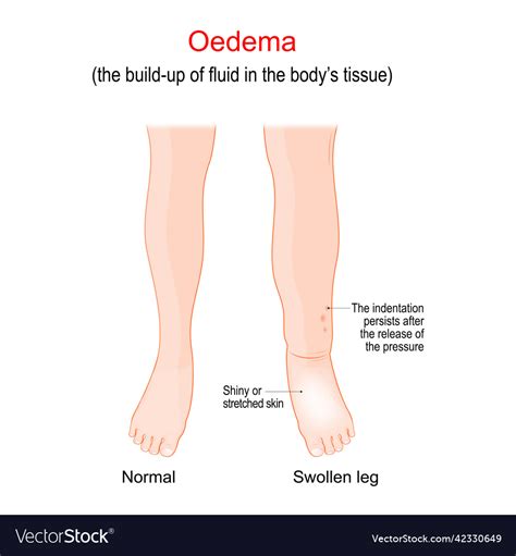 Edema Swollen Ankles Feet And Legs Oedema Vector Image