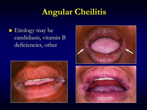Ppt Oral Manifestations Of Systemic Diseases Powerpoint Presentation