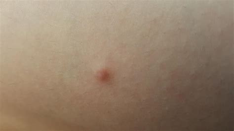 White Bump On Skin Cancer