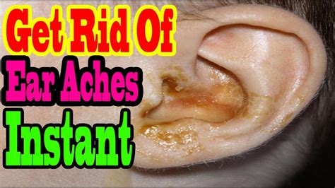 Earaches Relief Home Remedies And Treatment Best Home Remedies And