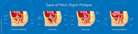 Pelvic Floor Prolapse Type Uterine Uterus Biofeedback Pelvic Floor