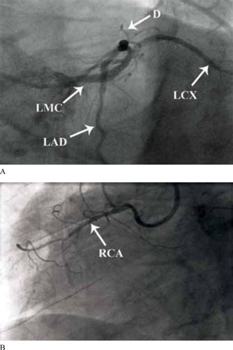 A Left Coronary Angiogram In Left Anterior Oblique La Open I