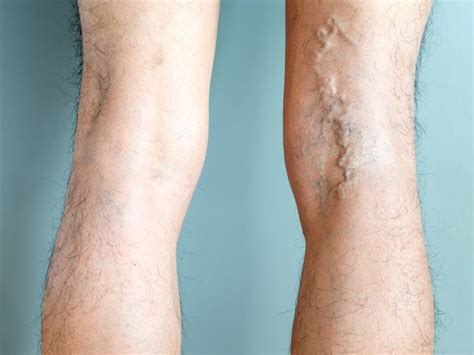 What Are The Major Risks Associated With Varicose Vein