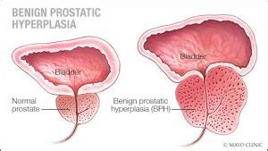 Mayo Clinic Q And A New Steam Treatment For Benign Prostatic Hyperplasia Mayo Clinic News Network