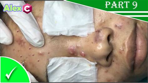 How To Removal Big Pimple Popping Cystic Acne Extraction Skincare Fda Youtube