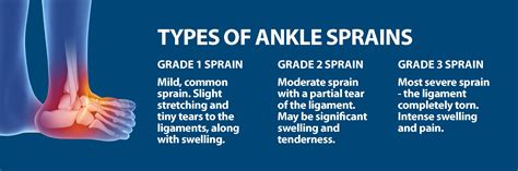 Grade 2 Ligament Tear Ankle Ankle Sprains Grades Ankle Ligament