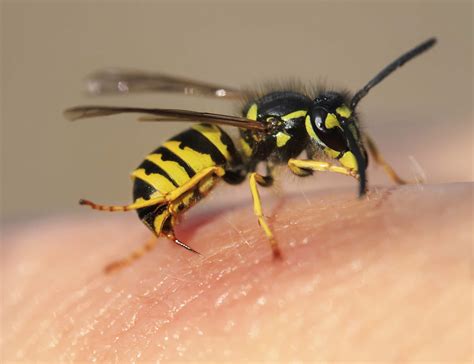 how to treat a bee sting uofl health