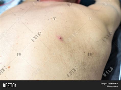 Pimple On Skin Light Image And Photo Free Trial Bigstock