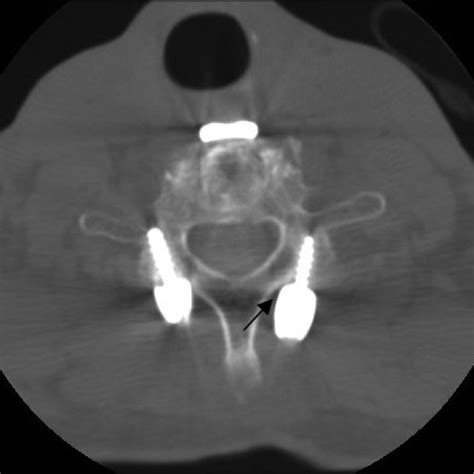 Pdf Clinical Outcome Of Modified Cervical Lateral Mass Screw Fixation