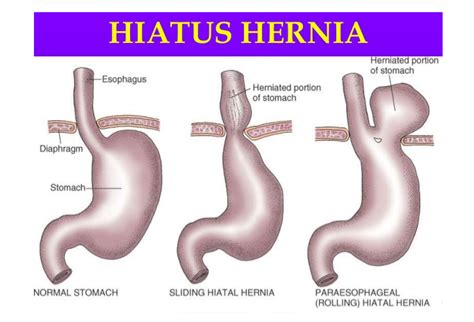 Is A Cm Hernia Large