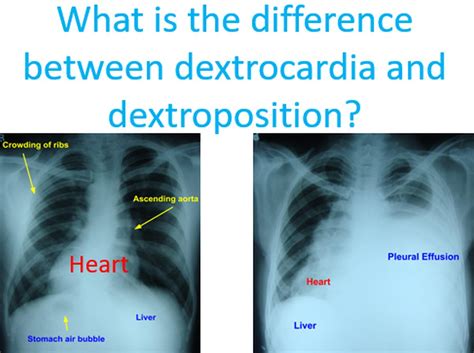 What Is The Difference Between Dextrocardia And Dextroposition All