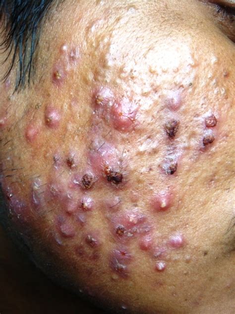 Very Severe Nodulocystic Acne Faq Skin Care Tips From Dermatologist