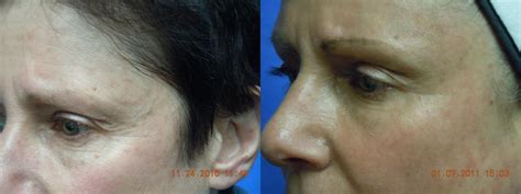 Laser Skin Rejuvenation Before And After Pictures Case 13 Coeur D