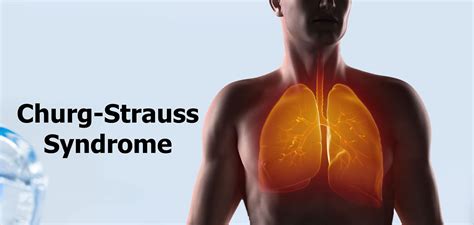Churg Strauss Syndrome Causes Symptoms Diagnosis Treatment