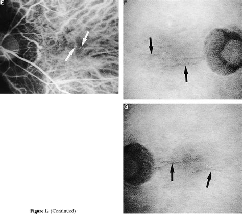 Figure 1 From Indocyanine Green Angiographic Findings Of Lacquer Cracks