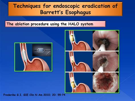 PPT Endoscopic Mucosal Resection Vs Radiofrequency Ablation In