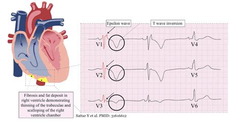 Arvd Arrhytmogenic Right Ventricular Cardiomyopathydysplasia Ecg