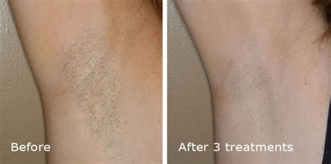 Laser Hair Removal City Dermatology And Laser
