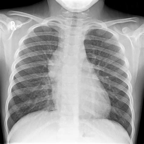 Chest X Ray Normal Results Chest X Ray Findings Monitoring Covid 19