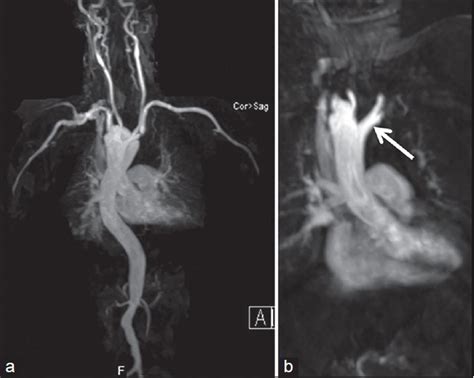 Imaging Findings In The Right Aortic Arch With Mirror Image Branching