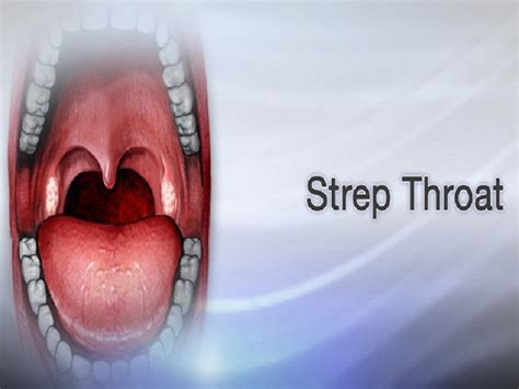 The Incredible Impact Of Strep Throat Without Tonsils Iktix