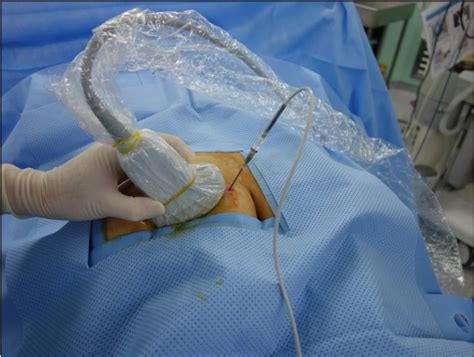 Pulsed Radiofrequency Treatment Prf For Pudendal Neuralgia